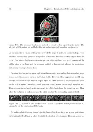 84 Chapter 4. Localisation of the brain in fetal MRI
Figure 4.10: The proposed localisation method is robust to low signal-to-noise ratio. The
selected MSER regions are highlighted in red and the detected bounding box in green.
On the contrary, a coronal or transverse view of the lungs do not have a similar shape. This
hinders a slice-by-slice approach independent of the scan direction for other organs than the
brain. Due to the slice-by-slice detection process, there needs to be a good coverage of the
middle slices of the brain and the proposed method is therefore not adapted for acquisitions
with a large spacing between slices.
Gaussian blurring and the mean shift algorithm are other approaches that accumulate votes
from a detection process such as in Section 4.3.4. However, these approaches would only
consider the center of each detected ellipse, while RANSAC enables to incorporate constraints
on the MSER regions themselves, which must not extend beyond the detected bounding box.
These constraints are based on the estimated size of the brain from the gestational age. They
allow the exclusion of outliers such as the whole head or the surrounding amniotic ﬂuid.
Figure 4.11: As a result of fetal head rotation, the eyes of the fetus do not provide robust 3D
landmarks for the localisation of the brain.
Beyond the clinical interest in analysing the brain of the fetus, there are several motivations
for localising the fetal brain as a ﬁrst step in the localisation of fetal organs. The main arguments
 