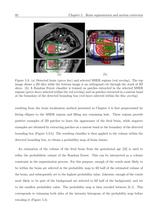 92 Chapter 5. Brain segmentation and motion correction
(a) (b)
Figure 5.3: (a) Detected brain (green box) and selected MSER regions (red overlay). The top
image shows a 2D slice while the bottom image is an orthogonal cut through the stack of 2D
slices. (b) A Random Forest classiﬁer is trained on patches extracted in the selected MSER
regions (green boxes selected within the red overlay) and on patches extracted in a narrow band
at the boundary of the detected bounding box (red boxes selected within the blue overlay)
.
resulting from the brain localisation method presented in Chapter 4 is ﬁrst preprocessed by
ﬁtting ellipses to the MSER regions and ﬁlling any remaining hole. These regions provide
positive examples of 2D patches to learn the appearance of the fetal brain, while negative
examples are obtained by extracting patches on a narrow band at the boundary of the detected
bounding box (Figure 5.3.b). The resulting classiﬁer is then applied to the volume within the
detected bounding box, to obtain a probability map of brain tissues.
An estimation of the volume of the fetal brain from the gestational age [22] is used to
reﬁne the probabilistic output of the Random Forest. This can be interpreted as a volume
constraint in the segmentation process. For this purpose, enough of the voxels most likely to
be within the brain are selected in the probability map to ﬁll half of the estimated volume of
the brain, and subsequently set to the highest probability value. Likewise, enough of the voxels
most likely to be part of the background are selected to ﬁll half of the background, and set
to the smallest probability value. The probability map is then rescaled between [0, 1]. This
corresponds to trimming both sides of the intensity histogram of the probability map before
rescaling it (Figure 5.4).
 
