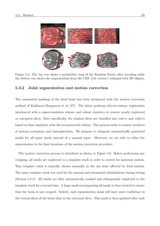 5.3. Method 95
Figure 5.5: The top row shows a probability map of the Random Forest after rescaling while
the bottom row shows the segmentation from the CRF (red contour) enlarged with 2D ellipses.
5.3.2 Joint segmentation and motion correction
The automated masking of the fetal brain has been integrated with the motion correction
method of Kuklisova-Murgasova et al. [87]. The latter performs slice-to-volume registration
interleaved with a super-resolution scheme and robust statistics to remove poorly registered
or corrupted slices. More speciﬁcally, the original slices are classiﬁed into inliers and outliers
based on their similarity with the reconstructed volume. This process seeks to remove artefacts
of motion corruption and misregistration. We propose to integrate automatically generated
masks for all input stacks instead of a manual input. Moreover, we are able to reﬁne the
segmentation in the ﬁnal iterations of the motion correction procedure.
The motion correction process is initialised as shown in Figure 5.6. Before performing any
cropping, all stacks are registered to a template stack in order to correct for maternal motion.
This template stack is typically chosen manually as the one least aﬀected by fetal motion.
The same template stack was used for the manual and automated initialisations during testing
(Section 5.5.2). All stacks are then automatically masked and subsequently registered to the
template stack for a second time. A large mask encompassing all masks is then created to ensure
that the brain is not cropped. Indeed, each segmentation mask will have more conﬁdence in
the central slices of the brain than in the extremal slices. This mask is then updated after each
 