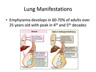 Lung Manifestations
• Emphysema develops in 60-70% of adults over
25 years old with peak in 4th and 5th decades
 