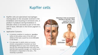 Kupffer cells
 Kupffer cells are specialised macrophages
moving about in the sinusoids involved in the
breakdown and recycling of red blood cells. A
product it produces during breakdown is
bilirubin which is excreted as part of the bile
and in faces. Bilirubin is the brown pigment is
faeces.
 Application Scenario:
 A common condition in newborns, jaundice
refers to the yellow color of the skin and
whites of the eyes caused by excess bilirubin
in the blood.
 It is also seen in adults where an excess
chronic consumption of alcohol can have
damaging effects on your liver meaning that
you are not removing bilirubin from your liver
and bile ducts quickly enough, as it builds up in
the blood it is deposited in the skin… The
resulting is jaundice.
5/17/2015 15
 