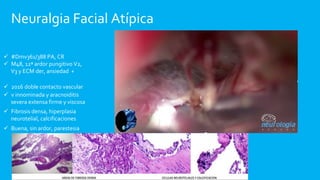 Neuralgia Facial Atípica
 #Dmv361/388 PA, CR
 M48, 12ª ardor pungitivo V2,
V3 y ECM der, ansiedad +
 2016 doble contact...
