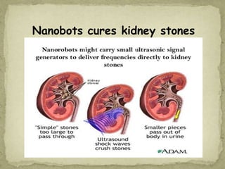 Nanobots cures kidney stones
 