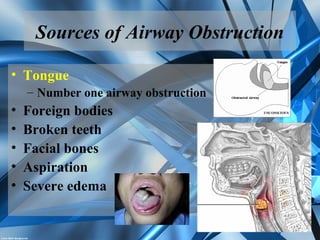 Sources of Airway Obstruction
• Tongue
– Number one airway obstruction
• Foreign bodies
• Broken teeth
• Facial bones
• Aspiration
• Severe edema
 