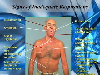 Nasal flaringNasal flaring
ExcessiveExcessive
useuse
of accessoryof accessory
musclesmuscles
ChestChest
TightnessTightness
CyanosisCyanosis
Numbness,Numbness,
tingling intingling in
hands & feethands & feet
Pursed lipsPursed lips
Coughing, high-Coughing, high-
pitched barkpitched bark
RespiratoryRespiratory
noisenoise crowing,crowing,
• wheezingwheezing
• rattlingrattling
Impaired mentalImpaired mental
statuesstatues
• unconsciousnessunconsciousness
• dizziness/faintingdizziness/fainting
• restlessnessrestlessness
• anxietyanxiety
• confusionconfusion
• combativenesscombativeness
Signs of Inadequate Respirations
 