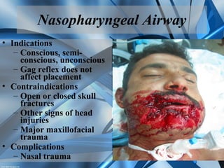 Nasopharyngeal Airway
• Indications
– Conscious, semi-
conscious, unconscious
– Gag reflex does not
affect placement
• Contraindications
– Open or closed skull
fractures
– Other signs of head
injuries
– Major maxillofacial
trauma
• Complications
– Nasal trauma
 