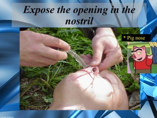 Expose the opening in the
nostril
* Pig nose
 