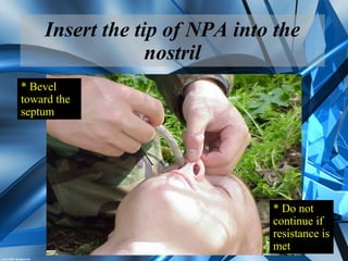 Insert the tip of NPA into the
nostril
* Bevel
toward the
septum
* Do not
continue if
resistance is
met
 