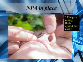 NPA in place
* Flange is
resting
flush
against the
nostril
 
