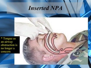 Inserted NPA
* Tongue as
an airway
obstruction is
no longer a
concern
 