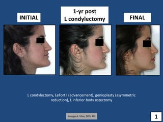 1-yr post
L condylectomy FINALINITIAL
L condylectomy, LeFort I (advancement), genioplasty (asymmetric
reduction), L inferior body ostectomy
George A. Vilos, DDS, MS
1
 