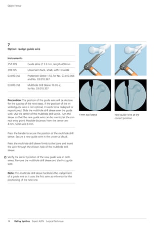 A2FN Synthes dsem trm-1015-0537-1-lr | PDF