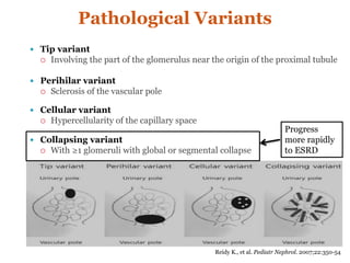 Pathological Variants
 Tip variant
 Involving the part of the glomerulus near the origin of the proximal tubule
 Perihilar variant
 Sclerosis of the vascular pole
 Cellular variant
 Hypercellularity of the capillary space
 Collapsing variant
 With ≥1 glomeruli with global or segmental collapse
Reidy K., et al. Pediatr Nephrol. 2007;22:350-54
Progress
more rapidly
to ESRD
 
