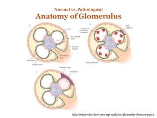 Normal vs. Pathological
Anatomy of Glomerulus
http://what-when-how.com/acp-medicine/glomerular-diseases-part-4
 