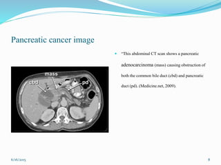 Pancreatic cancer image
 “This abdominal CT scan shows a pancreatic
adenocarcinoma (mass) causing obstruction of
both the common bile duct (cbd) and pancreatic
duct (pd). (Medicine.net, 2009).
6/16/2015 8
 