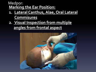 Medpor:
Marking the Ear Position:
1. Lateral Canthus, Alae, Oral Lateral
Commisures
2. Visual Inspection from multiple
angles from frontal aspect
 