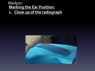 Medpor:
Marking the Ear Position:
1. Close up of the radiograph
 