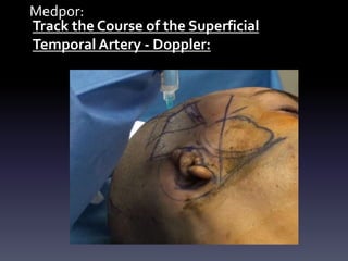 Medpor:
Track the Course of the Superficial
Temporal Artery - Doppler:
 