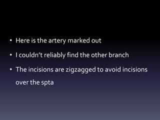 • Here is the artery marked out
• I couldn’t reliably find the other branch
• The incisions are zigzagged to avoid incisions
over the spta
 