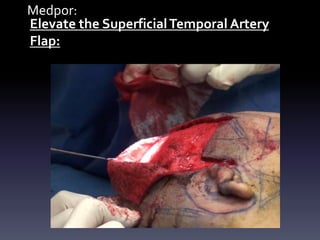 Medpor:
Elevate the SuperficialTemporal Artery
Flap:
 