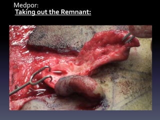 Medpor:
Taking out the Remnant:
 