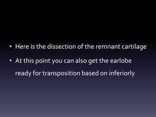 • Here is the dissection of the remnant cartilage
• At this point you can also get the earlobe
ready for transposition based on inferiorly
 