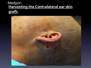 Medpor:
Harvesting the Contralateral ear skin
graft:
 