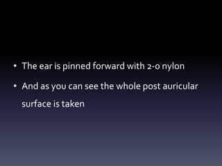 • The ear is pinned forward with 2-0 nylon
• And as you can see the whole post auricular
surface is taken
 