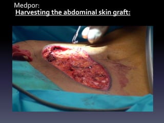 Medpor:
Harvesting the abdominal skin graft:
 