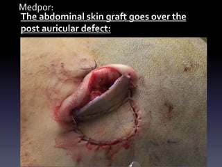 Medpor:
The abdominal skin graft goes over the
post auricular defect:
 