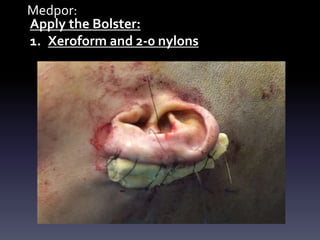 Medpor:
Apply the Bolster:
1. Xeroform and 2-0 nylons
 