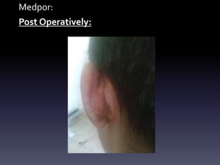 Medpor:
Post Operatively:
 