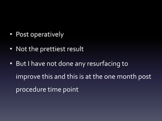 • Post operatively
• Not the prettiest result
• But I have not done any resurfacing to
improve this and this is at the one month post
procedure time point
 