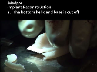 Medpor:
Implant Reconstruction:
1. The bottom helix and base is cut off
 