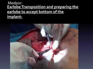 Medpor:
EarlobeTransposition and preparing the
earlobe to accept bottom of the
implant:
 
