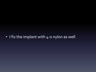 • I fix the implant with 4-0 nylon as well
 
