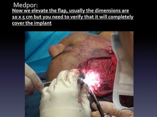 Medpor:
Now we elevate the flap, usually the dimensions are
10 x 5 cm but you need to verify that it will completely
cover the implant
 