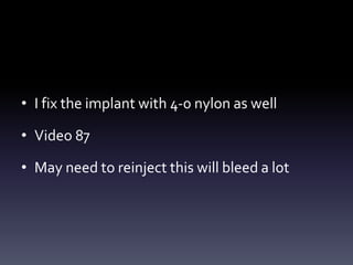 • I fix the implant with 4-0 nylon as well
• Video 87
• May need to reinject this will bleed a lot
 