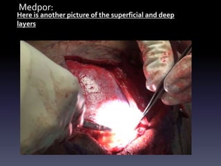 Medpor:
Here is another picture of the superficial and deep
layers
 