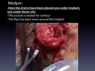 Medpor:
-Here the drains have been placed one under implant,
one under donor site
-The suction is tested for contour
-The flap has been sewn around the implant
 