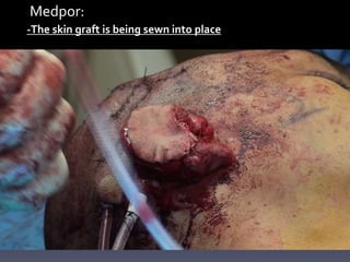 Medpor:
-The skin graft is being sewn into place
 