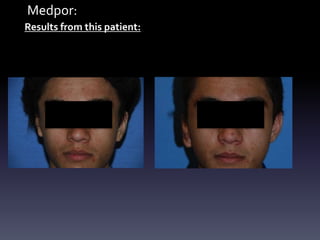 Medpor:
Results from this patient:
 