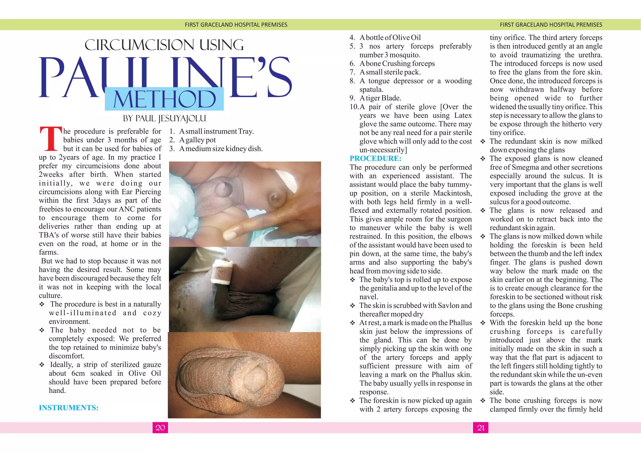 FIRST GRACELAND HOSPITAL PREMISES FIRST GRACELAND HOSPITAL PREMISES
CIRCUMCISION USING
PAULINE'S
The procedure is preferable for
babies under 3 months of age
but it can be used for babies of
up to 2years of age. In my practice I
prefer my circumcisions done about
2weeks after birth. When started
initially, we were doing our
circumcisions along with Ear Piercing
within the first 3days as part of the
freebies to encourage our ANC patients
to encourage them to come for
deliveries rather than ending up at
TBA's of worse still have their babies
even on the road, at home or in the
farms.
But we had to stop because it was not
having the desired result. Some may
have been discouraged because they felt
it was not in keeping with the local
culture.
vThe procedure is best in a naturally
well-illuminated and cozy
environment.
vThe baby needed not to be
completely exposed: We preferred
the top retained to minimize baby's
discomfort.
vIdeally, a strip of sterilized gauze
about 6cm soaked in Olive Oil
should have been prepared before
hand.
INSTRUMENTS:
METHOD
By Paul Jesuyajolu
1. AsmallinstrumentTray.
2. Agalleypot
3. Amediumsizekidneydish.
4. AbottleofOliveOil
5. 3 nos artery forceps preferably
number3mosquito.
6. AboneCrushingforceps
7. Asmallsterilepack.
8. A tongue depressor or a wooding
spatula.
9. AtigerBlade.
10.A pair of sterile glove [Over the
years we have been using Latex
glove the same outcome. There may
not be any real need for a pair sterile
glove which will only add to the cost
un-necessarily]
The procedure can only be performed
with an experienced assistant. The
assistant would place the baby tummy-
up position, on a sterile Mackintosh,
with both legs held firmly in a well-
flexed and externally rotated position.
This gives ample room for the surgeon
to maneuver while the baby is well
restrained. In this position, the elbows
of the assistant would have been used to
pin down, at the same time, the baby's
arms and also supporting the baby's
headfrommovingsidetoside.
vThe baby's top is rolled up to expose
the genitalia and up to the level of the
navel.
vThe skin is scrubbed with Savlon and
thereaftermopeddry
vAt rest, a mark is made on the Phallus
skin just below the impressions of
the gland. This can be done by
simply picking up the skin with one
of the artery forceps and apply
sufficient pressure with aim of
leaving a mark on the Phallus skin.
The baby usually yells in response in
response.
vThe foreskin is now picked up again
with 2 artery forceps exposing the
PROCEDURE:
tiny orifice. The third artery forceps
is then introduced gently at an angle
to avoid traumatizing the urethra.
The introduced forceps is now used
to free the glans from the fore skin.
Once done, the introduced forceps is
now withdrawn halfway before
being opened wide to further
widenedtheusuallytinyorifice.This
step is necessary to allow the glans to
be expose through the hitherto very
tinyorifice.
vThe redundant skin is now milked
down exposingtheglans
vThe exposed glans is now cleaned
free of Smegma and other secretions
especially around the sulcus. It is
very important that the glans is well
exposed including the grove at the
sulcusforagoodoutcome.
vThe glans is now released and
worked on to retract back into the
redundantskinagain.
vThe glans is now milked down while
holding the foreskin is been held
between the thumb and the left index
finger. The glans is pushed down
way below the mark made on the
skin earlier on at the beginning. The
is to create enough clearance for the
foreskin to be sectioned without risk
to the glans using the Bone crushing
forceps.
vWith the foreskin held up the bone
crushing forceps is carefully
introduced just above the mark
initially made on the skin in such a
way that the flat part is adjacent to
the left fingers still holding tightly to
the redundant skin while the un-even
part is towards the glans at the other
side.
vThe bone crushing forceps is now
clamped firmly over the firmly held
2120
 