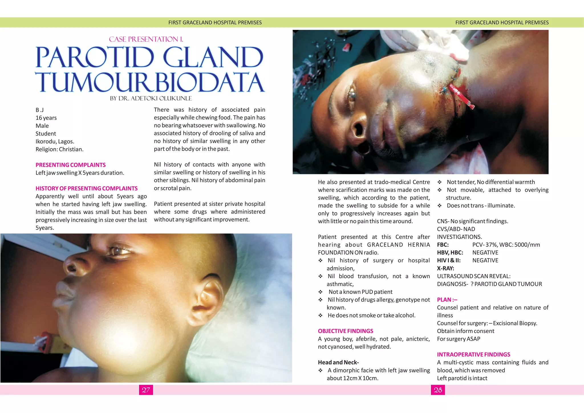 FIRST GRACELAND HOSPITAL PREMISES FIRST GRACELAND HOSPITAL PREMISES
CASE PRESENTATION 1.
By Dr. Adetoki Olukunle
PAROTID GLANDPAROTID GLAND
TUMOURBIODATATUMOURBIODATA
B.J
16years
Male
Student
Ikorodu,Lagos.
Religion:Christian.
LeftjawswellingX5yearsduration.
Apparently well until about 5years ago
when he started having left jaw swelling.
Initially the mass was small but has been
progressively increasing in size over the last
5years.
PRESENTINGCOMPLAINTS
HISTORYOFPRESENTINGCOMPLAINTS
There was history of associated pain
especially while chewing food. The pain has
nobearingwhatsoeverwithswallowing.No
associated history of drooling of saliva and
no history of similar swelling in any other
partofthebodyorinthepast.
Nil history of contacts with anyone with
similar swelling or history of swelling in his
other siblings. Nil history of abdominal pain
orscrotalpain.
Patient presented at sister private hospital
where some drugs where administered
withoutanysignificantimprovement.
He also presented at trado-medical Centre
where scarification marks was made on the
swelling, which according to the patient,
made the swelling to subside for a while
only to progressively increases again but
withlittleornopainthistimearound.
Patient presented at this Centre after
hearing about GRACELAND HERNIA
FOUNDATIONONradio.
vNil history of surgery or hospital
admission,
vNil blood transfusion, not a known
asthmatic,
vNotaknownPUDpatient
vNilhistoryofdrugsallergy,genotypenot
known.
vHedoesnotsmokeortakealcohol.
A young boy, afebrile, not pale, anicteric,
notcyanosed,wellhydrated.
HeadandNeck-
vA dimorphic facie with left jaw swelling
about12cmX10cm.
OBJECTIVEFINDINGS
vNottender,Nodifferentialwarmth
vNot movable, attached to overlying
structure.
vDoesnottrans-illuminate.
CNS-Nosignificantfindings.
CVS/ABD-NAD
INVESTIGATIONS.
FBC: PCV-37%,WBC:5000/mm
HBV,HBC: NEGATIVE
HIVI&II: NEGATIVE
X-RAY:
ULTRASOUNDSCANREVEAL:
DIAGNOSIS- ?PAROTIDGLANDTUMOUR
Counsel patient and relative on nature of
illness
Counselforsurgery:–ExcisionalBiopsy.
Obtaininformconsent
ForsurgeryASAP
A multi-cystic mass containing fluids and
blood,whichwasremoved
Leftparotidisintact
PLAN:–
INTRAOPERATIVEFINDINGS
2827
 