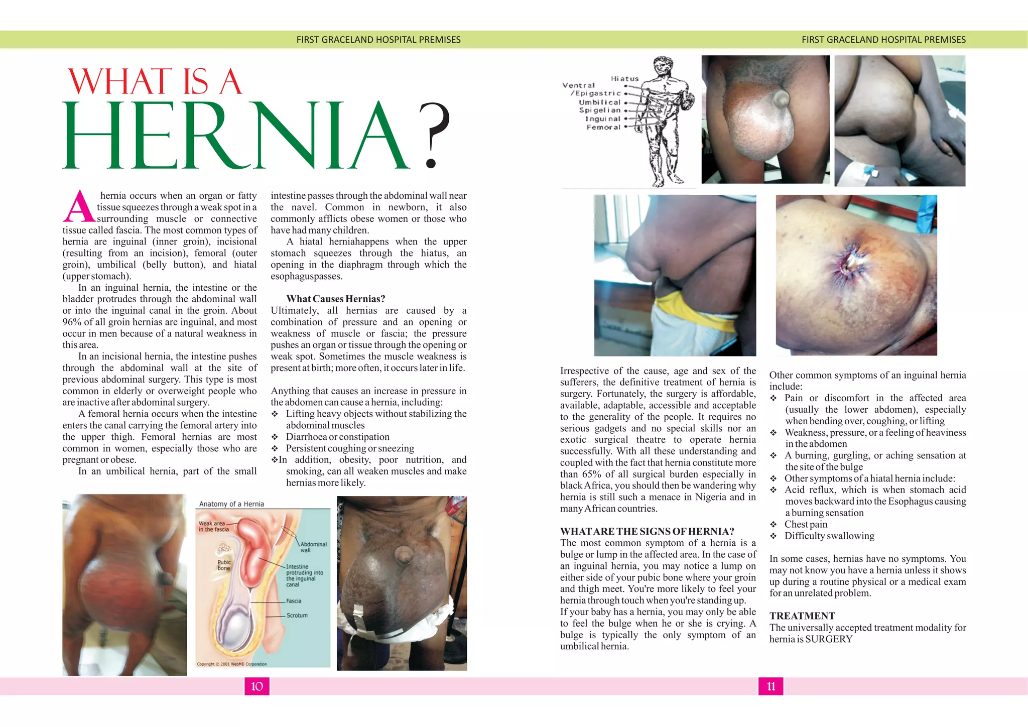 FIRST GRACELAND HOSPITAL PREMISES FIRST GRACELAND HOSPITAL PREMISES
WHAT IS A
HERNIA?
Ahernia occurs when an organ or fatty
tissue squeezes through a weak spot in a
surrounding muscle or connective
tissue called fascia. The most common types of
hernia are inguinal (inner groin), incisional
(resulting from an incision), femoral (outer
groin), umbilical (belly button), and hiatal
(upperstomach).
In an inguinal hernia, the intestine or the
bladder protrudes through the abdominal wall
or into the inguinal canal in the groin. About
96% of all groin hernias are inguinal, and most
occur in men because of a natural weakness in
thisarea.
In an incisional hernia, the intestine pushes
through the abdominal wall at the site of
previous abdominal surgery. This type is most
common in elderly or overweight people who
areinactiveafterabdominalsurgery.
A femoral hernia occurs when the intestine
enters the canal carrying the femoral artery into
the upper thigh. Femoral hernias are most
common in women, especially those who are
pregnantorobese.
In an umbilical hernia, part of the small
intestine passes through the abdominal wall near
the navel. Common in newborn, it also
commonly afflicts obese women or those who
havehadmanychildren.
A hiatal herniahappens when the upper
stomach squeezes through the hiatus, an
opening in the diaphragm through which the
esophaguspasses.
What Causes Hernias?
Ultimately, all hernias are caused by a
combination of pressure and an opening or
weakness of muscle or fascia; the pressure
pushes an organ or tissue through the opening or
weak spot. Sometimes the muscle weakness is
presentatbirth;moreoften,itoccurslaterinlife.
Anything that causes an increase in pressure in
theabdomencancauseahernia,including:
vLifting heavy objects without stabilizing the
abdominalmuscles
vDiarrhoeaorconstipation
vPersistentcoughingor sneezing
vIn addition, obesity, poor nutrition, and
smoking, can all weaken muscles and make
herniasmorelikely.
Irrespective of the cause, age and sex of the
sufferers, the definitive treatment of hernia is
surgery. Fortunately, the surgery is affordable,
available, adaptable, accessible and acceptable
to the generality of the people. It requires no
serious gadgets and no special skills nor an
exotic surgical theatre to operate hernia
successfully. With all these understanding and
coupled with the fact that hernia constitute more
than 65% of all surgical burden especially in
blackAfrica, you should then be wandering why
hernia is still such a menace in Nigeria and in
manyAfricancountries.
WHATARETHESIGNS OFHERNIA?
The most common symptom of a hernia is a
bulge or lump in the affected area. In the case of
an inguinal hernia, you may notice a lump on
either side of your pubic bone where your groin
and thigh meet. You're more likely to feel your
herniathroughtouchwhen you're standingup.
If your baby has a hernia, you may only be able
to feel the bulge when he or she is crying. A
bulge is typically the only symptom of an
umbilicalhernia.
Other common symptoms of an inguinal hernia
include:
vPain or discomfort in the affected area
(usually the lower abdomen), especially
when bendingover, coughing,orlifting
vWeakness, pressure, or a feeling of heaviness
intheabdomen
vA burning, gurgling, or aching sensation at
thesiteof thebulge
vOthersymptomsofahiatalherniainclude:
vAcid reflux, which is when stomach acid
moves backward into the Esophagus causing
aburningsensation
vChestpain
vDifficultyswallowing
In some cases, hernias have no symptoms. You
may not know you have a hernia unless it shows
up during a routine physical or a medical exam
for anunrelatedproblem.
TREATMENT
The universally accepted treatment modality for
herniaisSURGERY
1110
 
