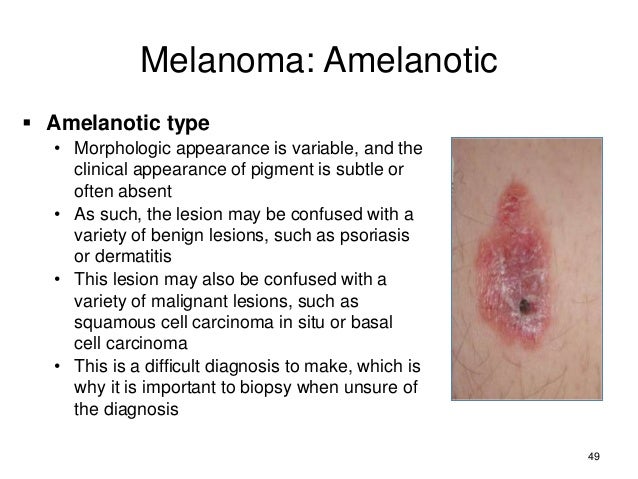 malignant melenoma essay Malignant melanoma is resistant to all forms of chemotherapy and surgery remains the basic instrument of curing melanoma at the earliest stages of the disease. malignant melenoma essay Malignant melanoma is resistant to all forms of chemotherapy and surgery remains the basic instrument of curing melanoma at the earliest stages of the disease.