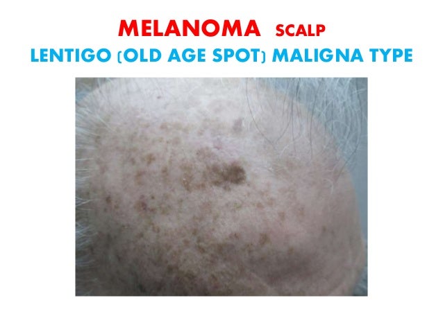 Skin Cancer A Curable Disease 16 Skin Cancer A Curable Disease 16