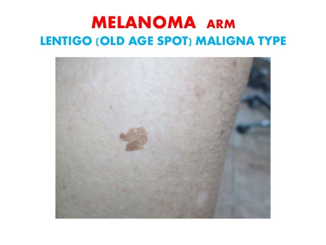 Skin Cancer A Curable Disease 16 Skin Cancer A Curable Disease 16