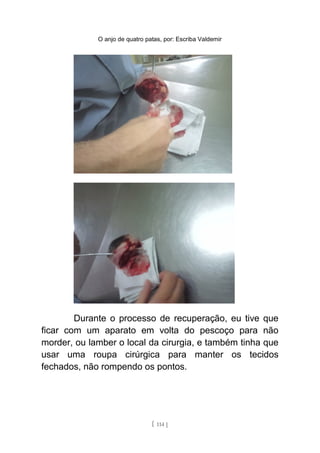 O anjo de quatro patas, por: Escriba Valdemir
Durante o processo de recuperação, eu tive que
ficar com um aparato em volta do pescoço para não
morder, ou lamber o local da cirurgia, e também tinha que
usar uma roupa cirúrgica para manter os tecidos
fechados, não rompendo os pontos.
[ 114 ]
 