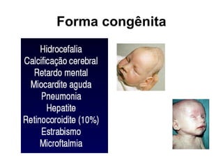 Forma congênita
 
